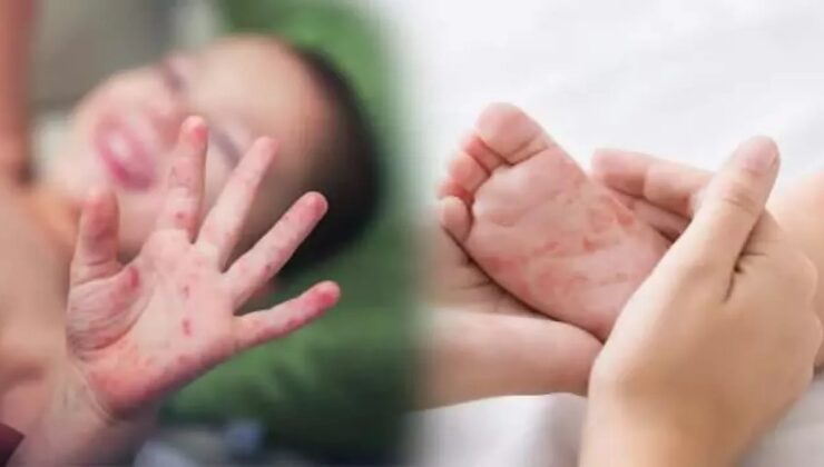 Çocuklarda el ayak ağız hastalığı nedir? Belirtileri ve tedavi yöntemleri nelerdir?
