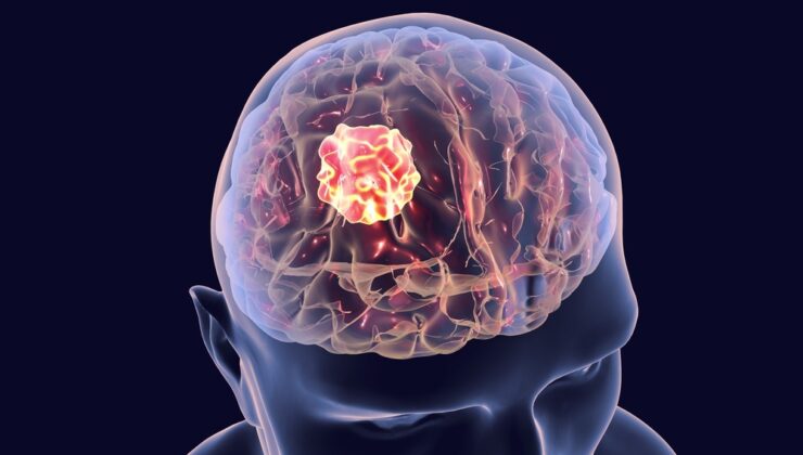 Viral Enfeksiyonlar Beyin Tümörü Riskini Artırabilir